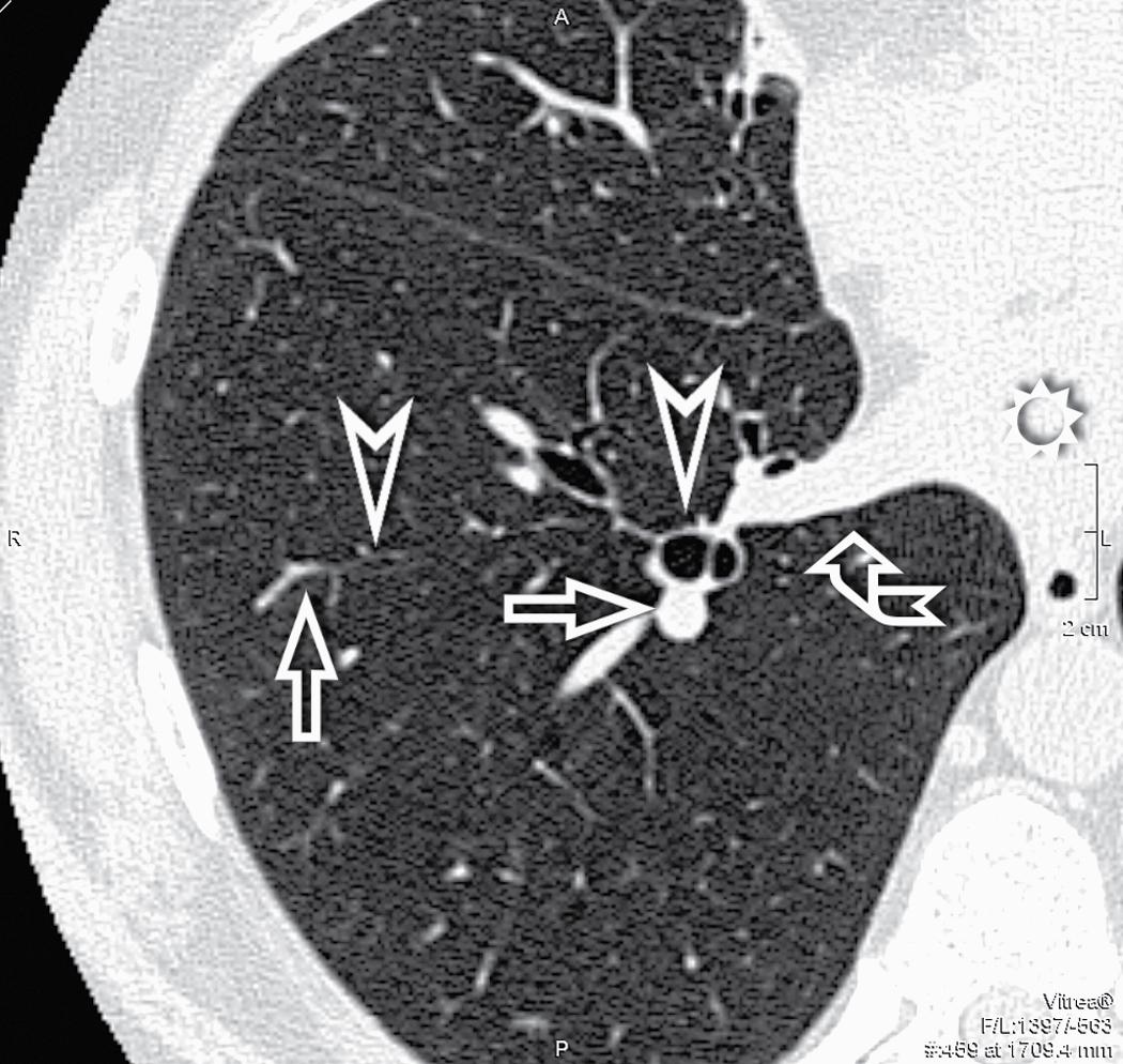 Figure 4.7, Arteries (arrows) and bronchi (arrowheads) run parallel to each other, and they are approximately the same size at every level. The right inferior pulmonary vein (curved arrow) enters the left atrium (sun) .