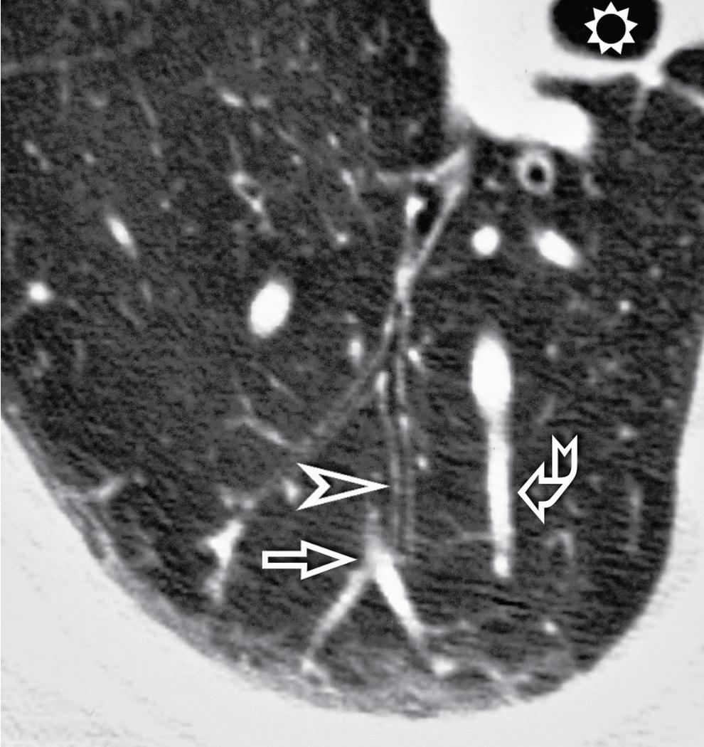 Figure 4.8, Close-up detail of the posterior portion of the right lung in an axial view at the level of the intermediate bronchus (sun) . Here we are facing the lobular level, with the centrilobular artery (arrow) and bronchiole (arrowhead) and a perilobular vein (curved arrow) .