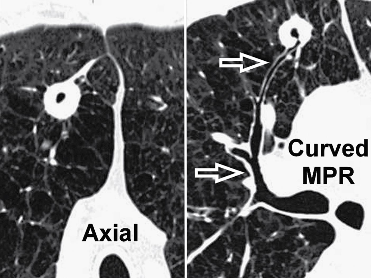Figure 4.9, Axial view (left) and curved reformatted image (right) of the right paramediastinal region in a patient with emphysema and a cavitary lesion of the lung. The axial image is in a plane. The right is artificially reconstructed along the drainage bronchus (arrows) ; however, it is effective in showing the bronchial ramifications from the hilum to the periphery. MPR , Multiplanar reformation.