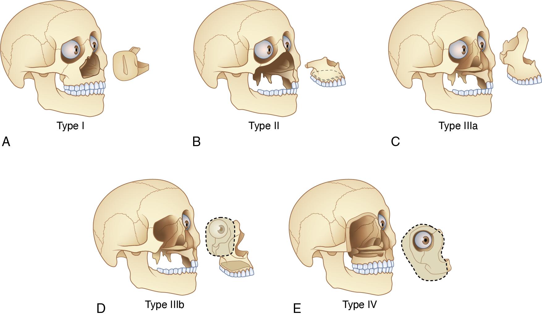 Fig. 7.3, Cordeiro classification of midface defects. (A) Type I: one or two walls of the maxilla excluding the palate. (B) Type II: lower five walls i.e., maxillary arch, palate, anterior and lateral walls. (C) Type IIIa: all six walls of the maxilla with orbital preservation. (D) Type IIIb: all six walls of the maxilla with orbital exenteration. (E) Type IV: upper five walls of the maxilla along with orbital contents, but with preservation of the palate.