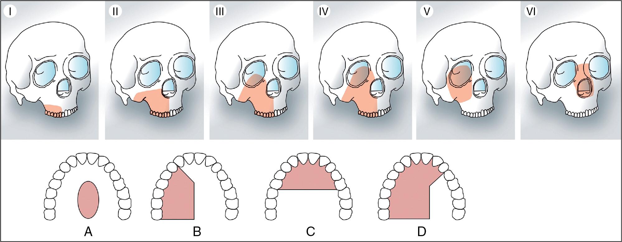 Fig. 7.4, Brown classification. Vertical classification: I—maxillectomy not causing an oronasal fistula; II—not involving the orbit; III—involving the orbital adnexae with orbital retention; IV—with orbital enucleation or exenteration; V—orbitomaxillary defect; VI—nasomaxillary defect. Horizontal classification: A—palatal defect only, not involving the dental alveolus; B—less than or equal to 1/2 unilateral; C—less than or equal to 1/2 bilateral or transverse anterior; D—greater than 1/2 maxillectomy. Letters refer to the increasing complexity of the dentoalveolar and palatal defect and qualify the vertical dimension.