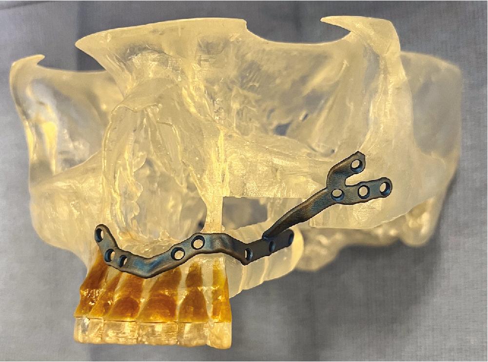 Fig. 7.5, Three-dimensional printed plate that captures bone segments and facial buttresses.