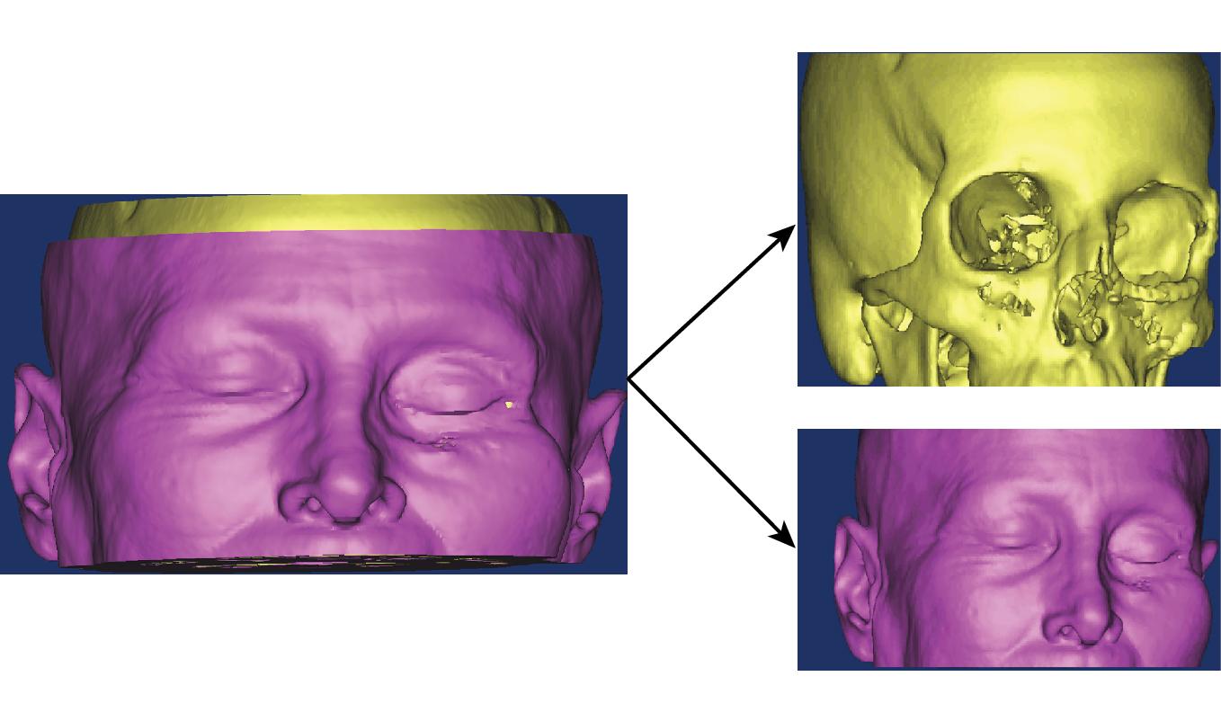 Fig. 4.3, Bone and soft tissue segmentation.