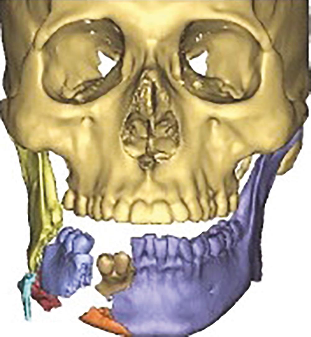 Fig. 19.2, Three-dimensional rendition of mandibular fracture using admission computed tomography.