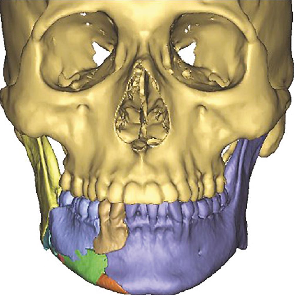 Fig. 19.3, Virtually reconstructed mandibular fracture using computer-assisted surgical planning.