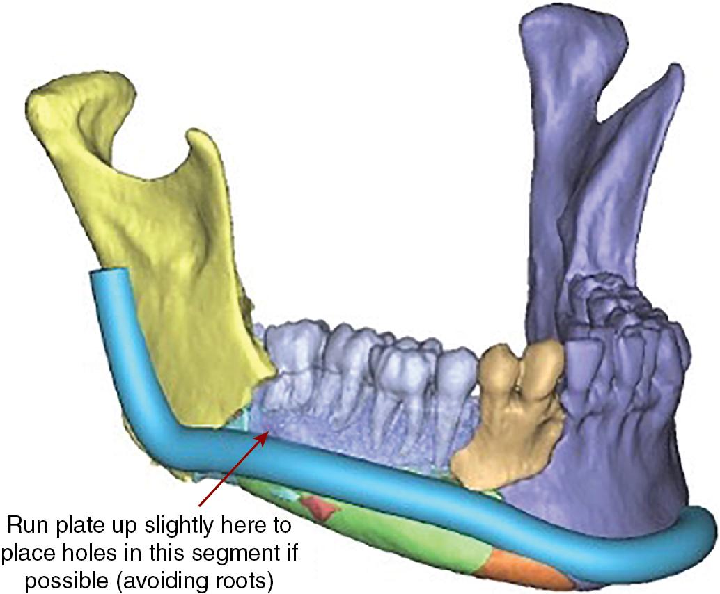 Fig. 19.4, Overlay of custom plate designed for fracture fixation.