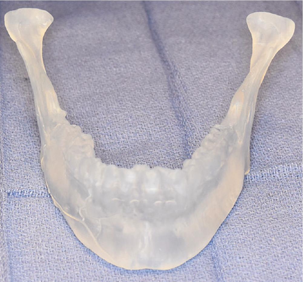 Fig. 19.5, 3D printed model of reconstructed mandibular fracture.