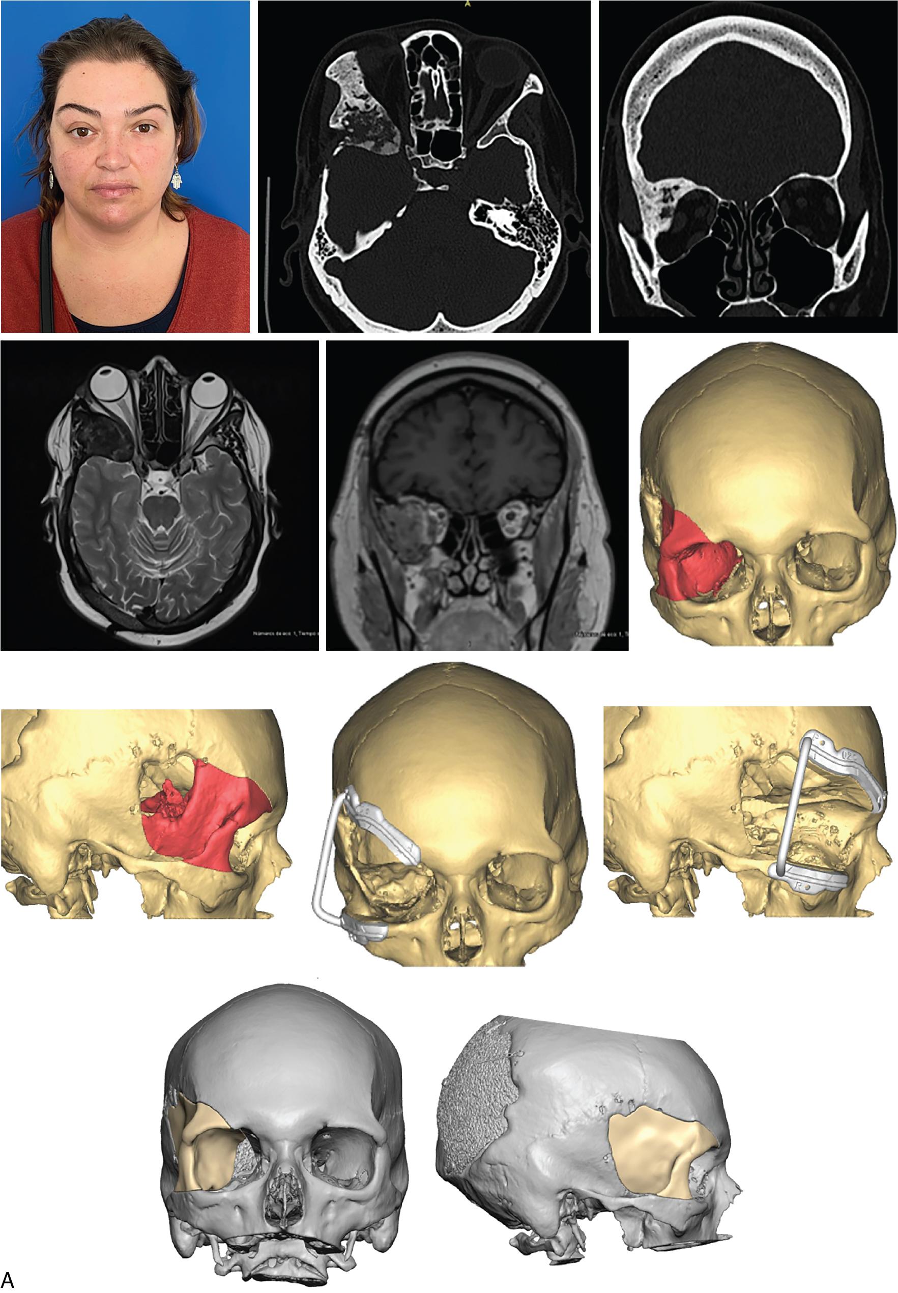 Fig. 21.2, (A) Computer-assisted design planning sequence. (B) Computer-assisted manufacturing. (C) Intraoperative aspects. (D) Intraoperative checking of the implant positioning.