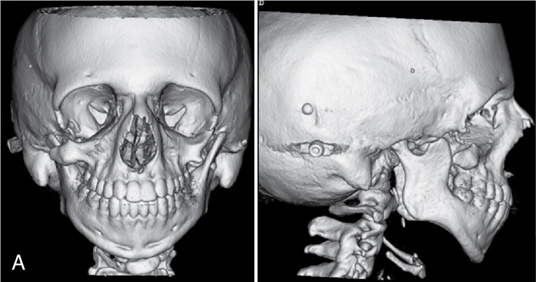 Fig. 14.1, Phenotypic variation in Treacher Collins syndrome (TCS). There is a wide degree of variability in presentations of TCS. In mild cases, the skeletal dysmorphology is characterized by structures that are functional, but small (A). In severe cases, there is aplasia of the involved skeletal structures (B). A common feature of TCS, regardless of the degree of skeletal hypoplasia, is clockwise rotation of the maxillomandibular complex, with a long anterior face height, short posterior face height, and steep mandibular and palatal plane angles. Reconstructive planning should aim to establish a stable cranio-mandibular articulation, normalize the facial plane angles and facial height ratios, address malar deficiency, and improve the sagittal positioning of the maxillomandibular complex in conjunction with establishing a functional occlusion.