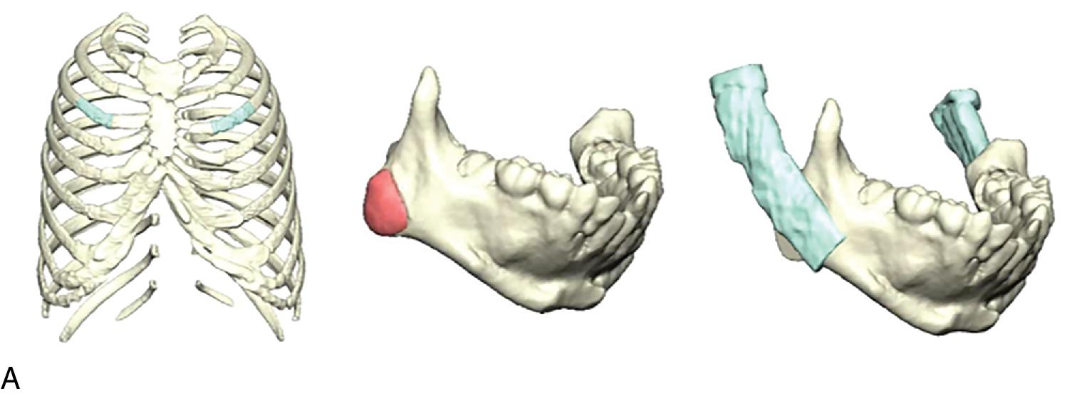 Fig. 14.3, Ramus-condyle unit construction. (A) Rib harvest, mandible resection, mandible reconstruction. (B) Right mandible rib reconstruction uses cohort third left rib. (C) Left mandible rib reconstruction uses cohort third right rib.
