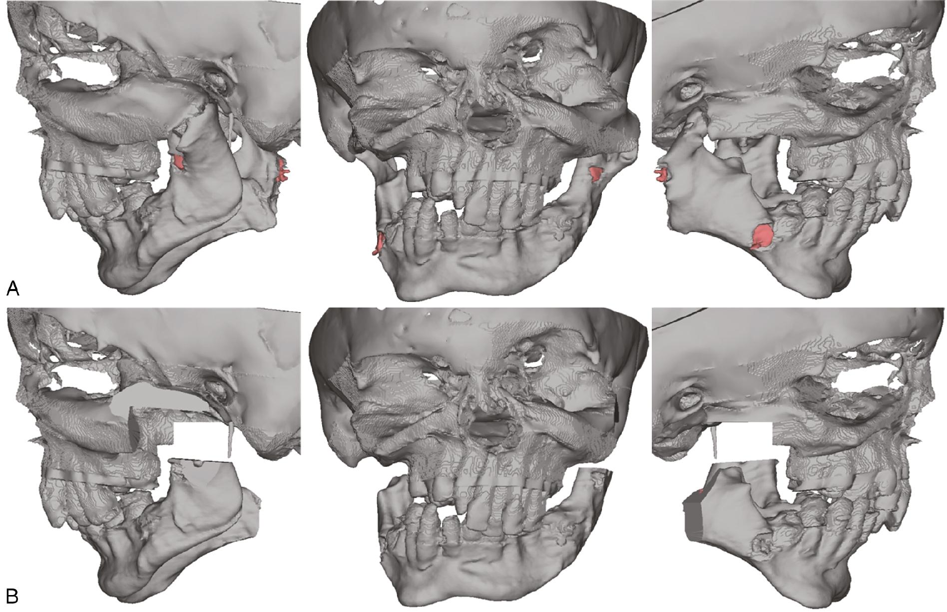 Fig. 9.1, A 17-year-old male patient born with severe Treacher Collins syndrome developed severe bilateral temporomandibular joint (TMJ) ankylosis as a complication of early mandibular distraction osteogenesis as an infant. This patient underwent bilateral TMJ replacement using custom alloplastic implants designed by computer-assisted surgical planning with computer-assisted design/computer-assisted manufacture technology. The preoperative position (A) and planned movements (B) are shown.