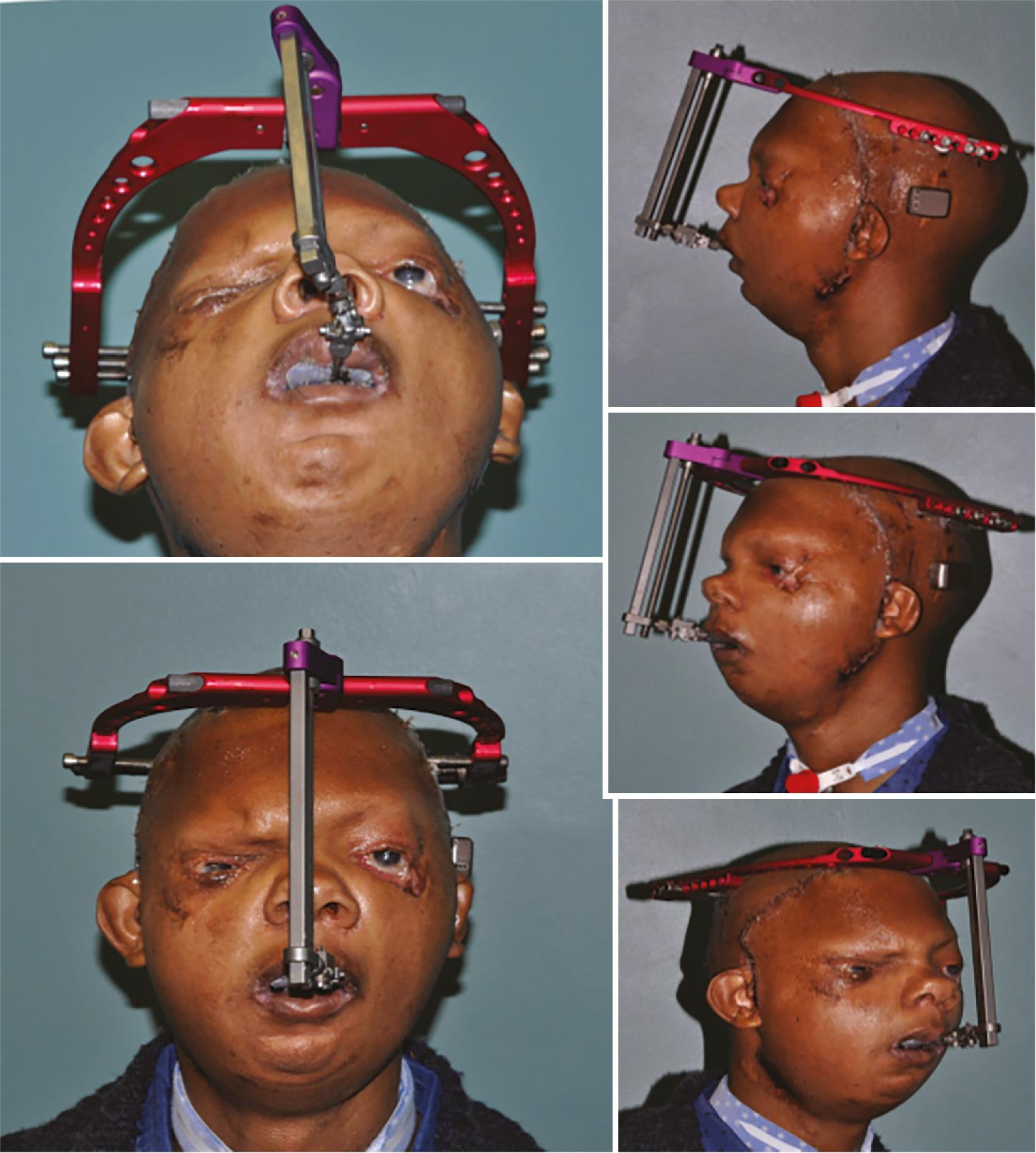 Fig. 9.4, The patient was fitted with a rigid external distraction halo device during the final stage of his mandibular reconstruction with bilateral temporomandibular joint replacement.