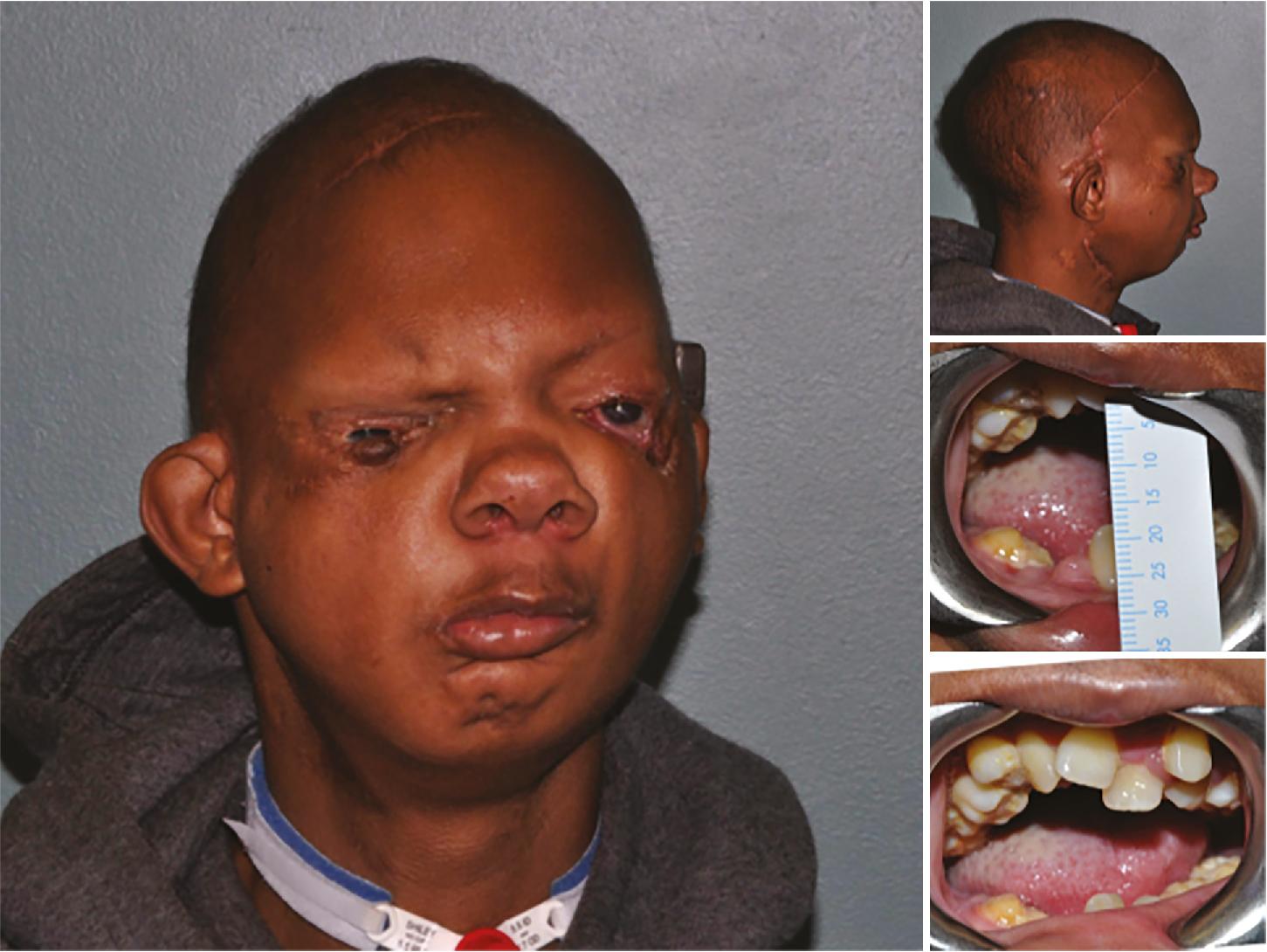 Fig. 9.5, Postoperative clinical features immediately following the removal of the rigid external distraction halo device, 3 months after distraction and consolidation.