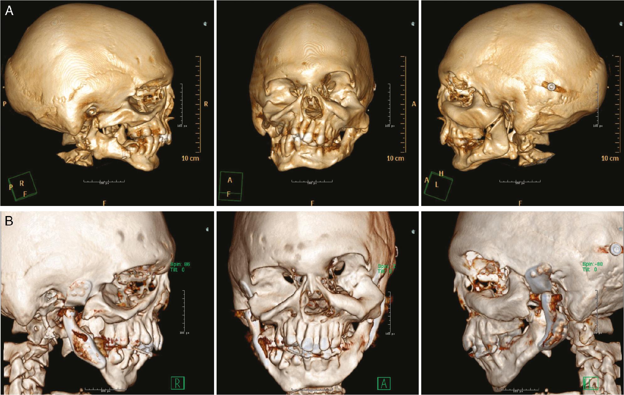 Fig. 9.6, Three-dimensional computed tomography imaging preoperatively (A) at 17 years and postoperatively (B) at 19 years and 2 months.