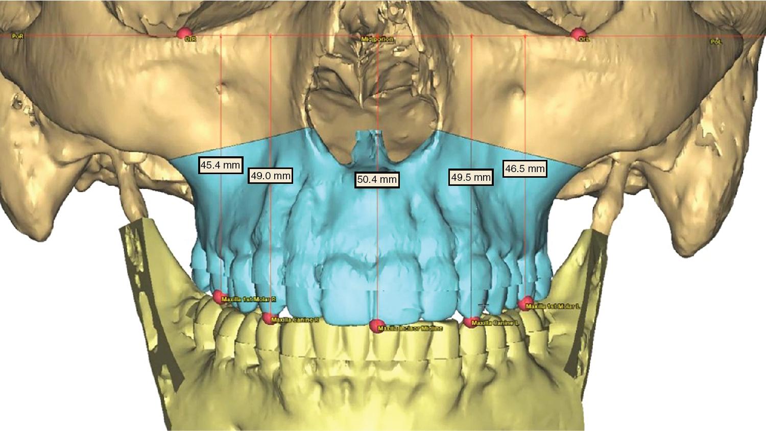Fig. 5.2, Level the cant. Begin leveling the cant by measuring the distance from the inferior orbital rim to the occlusal surface of the canine and first molar bilaterally.