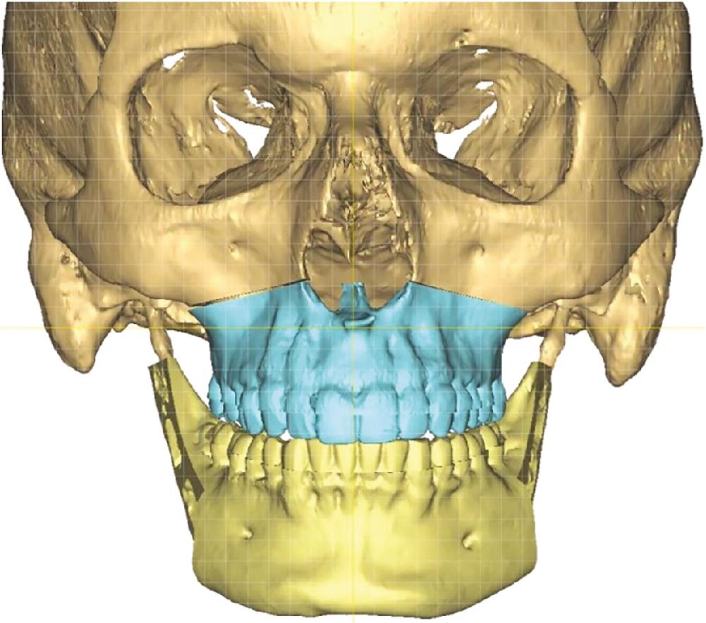 Fig. 5.3, Make skeletal and dental midline coincident. Next, bring the maxillary dental midline toward the midline so that it coincides with the skeletal midline.