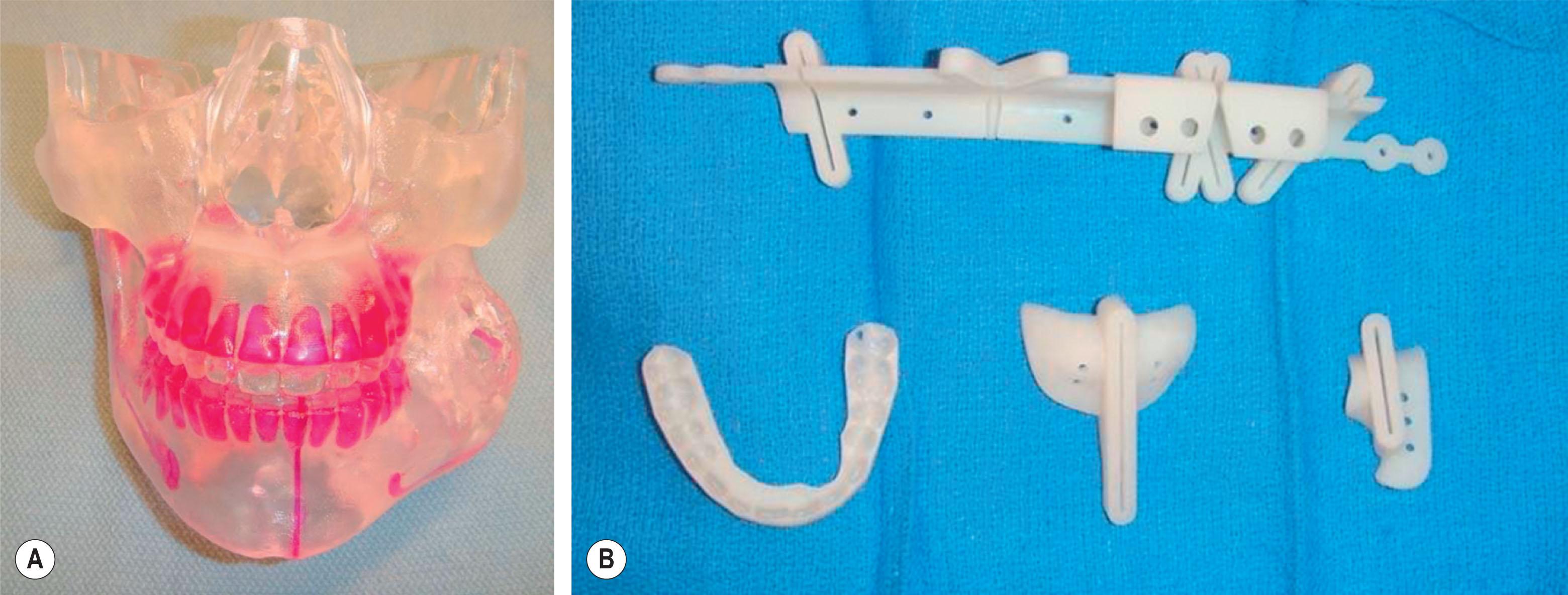Figure 6.3.1, (A) A stereolithographic model of the skull with the tumor and virtual cuts colored. (B) The cutting guide specific to the patient’s fibula and mandible are noted along with an occlusal splint.