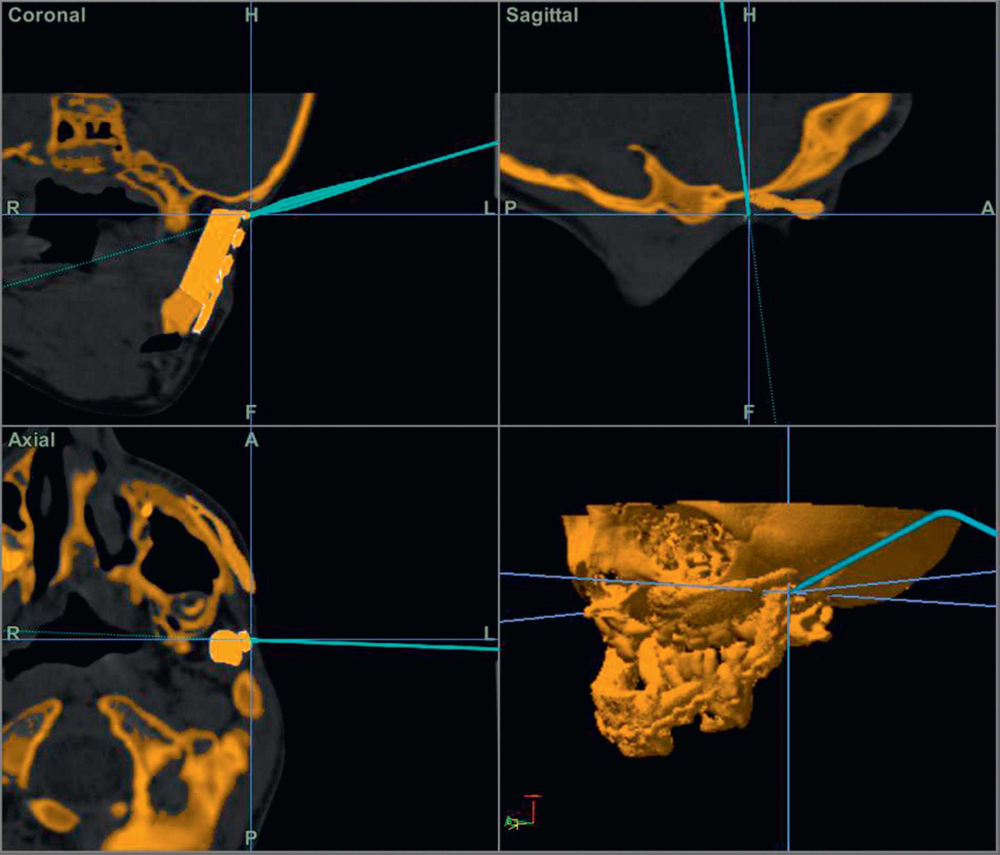 Figure 6.3.2, Guidance technology showing intra-operative positioning of the reconstructed segments. In this case, guidance technology was used to check the desired fibula positioning near the glenoid fossa.