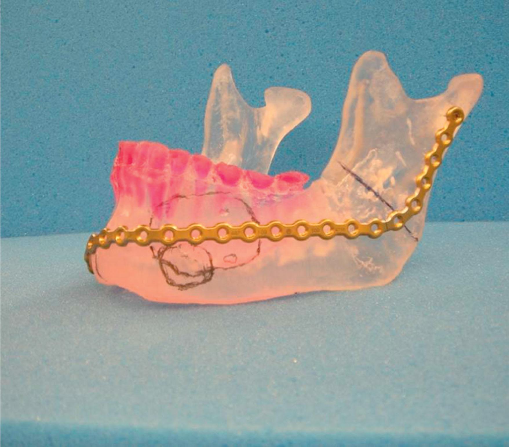 Figure 6.3.3, Stereolithographic model used as a template for plate bending, which can be performed prior to surgery. The plate can then be sterilized and subsequently used for intra-operative reconstruction and bone alignment.