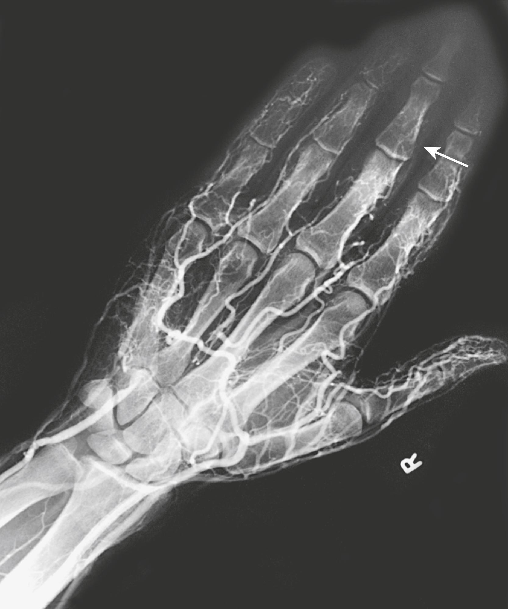 Figure 184.1, Arteriogram of the Hand in a Vibratory Tool Worker.