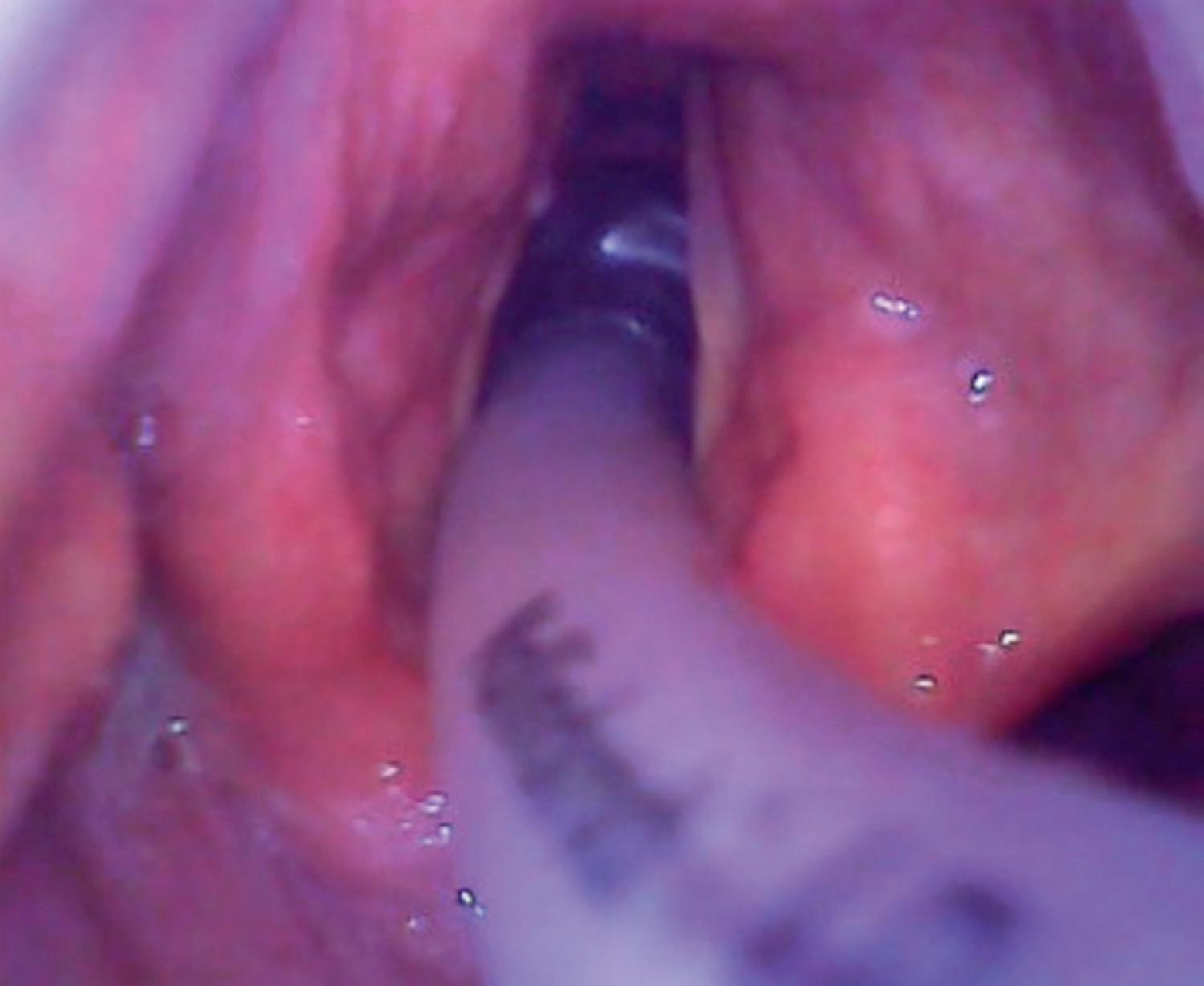 Fig. 30.1, Indirect (videolaryngoscopic) view of the glottic opening with the endotracheal tube and cuff visible beyond the vocal cords.