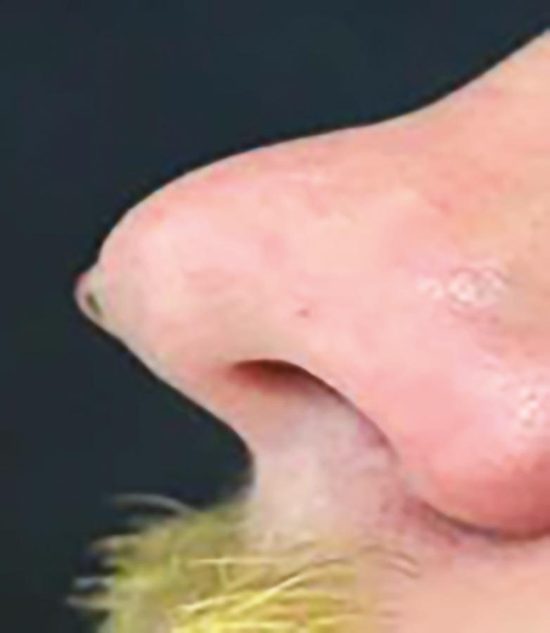 Fig. 3.1, A patient with CSF rhinorrhea. On physical examination, patients with cerebrospinal fluid (CSF) leaks may be misdiagnosed with normal nasal mucus because of a similar appearance. Analysis of nasal secretions is frequently needed to identify the presence of a CSF leak.