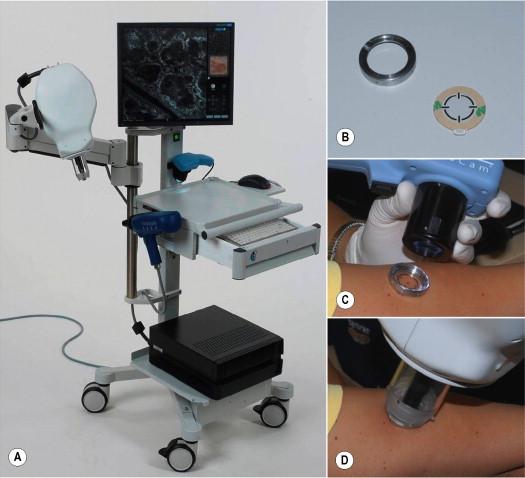 Figure 38.2, A) Reflectance confocal microscope equipped with a dermoscopic camera and a handheld probe (the darker blue device that resembles a drill). B) A metal adaptor ring (left upper corner) is attached to a disposable polymer disc (right lower corner). The metal ring provides the housing for the RCM probe. The polymer disc provides a window through which imaging is done and also provides a double-sided adhesive that sticks to the ring and secures it to the skin. C) A dermoscopic picture that serves as a gross map during RCM imaging is captured through the adaptor ring–polymer disc. D) The probe is coupled magnetically to the adaptor ring that is fixed to the skin. To reduce backscatter and distortion of light, crodamol oil is used as an immersion media between skin and the polymer window, and water-based gel is used between the polymer window and the RCM probe.