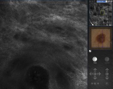 Figure 38.3, Screenshot from the Vivascope® computer during RCM imaging. Most of the screen is taken up by a single RCM image (500 × 500 μm, displayed on the left). A mosaic (3 × 3 mm) is also seen (right upper corner); the yellow square highlighted within the mosaic corresponds to location of the single RCM image displayed on the left. The mosaic and the dermoscopic image below the mosaic may serve as gross maps for RCM imaging. Both images can be viewed as enlarged pictures by toggling them with the single RCM images. The buttons in the right lower corner are used to navigate the RCM light within the tissue along the x-, y- and z-axis and to capture RCM images and videos.