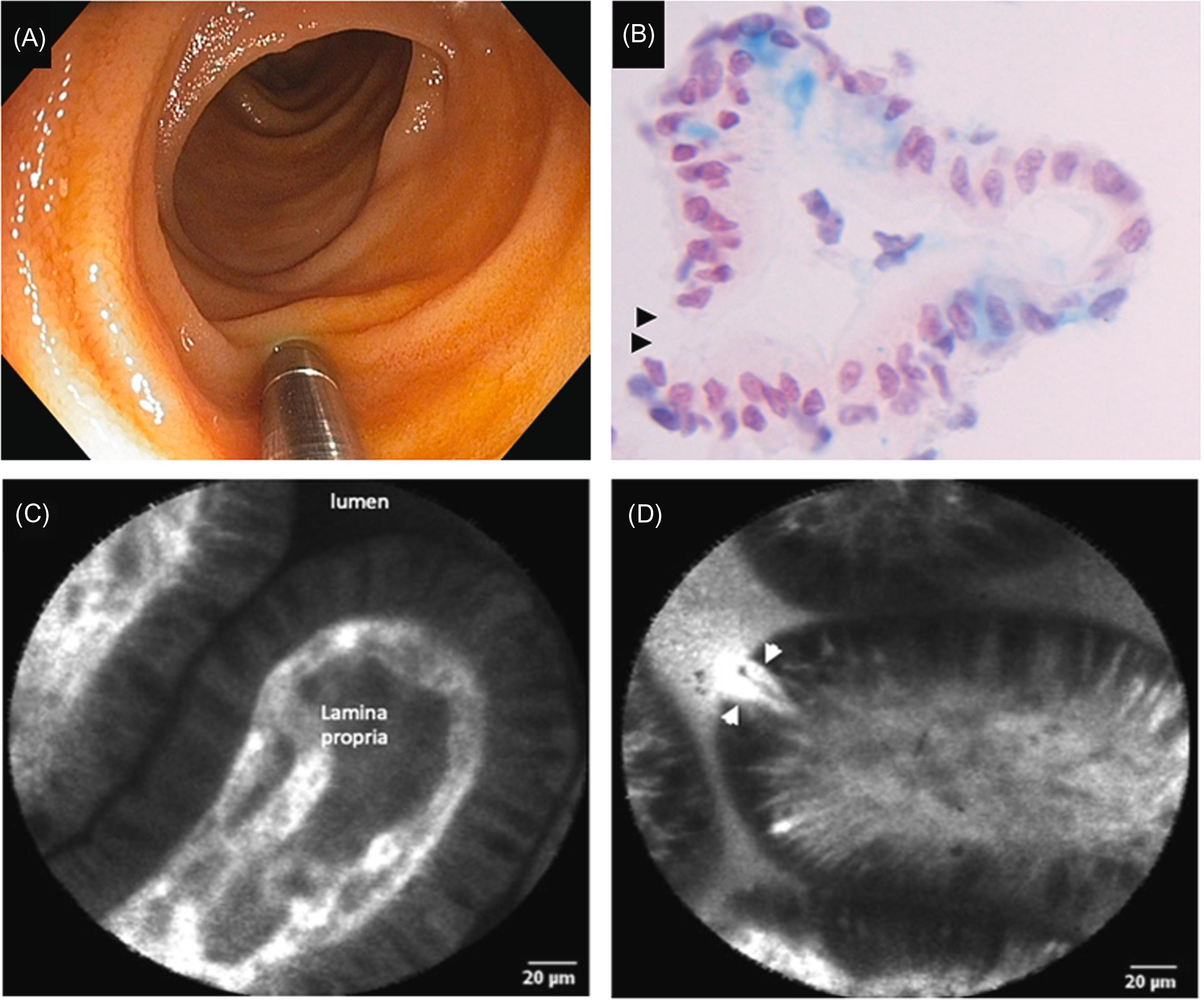 Figure 20.1, Whit-light endoscopy, pCLE, and light microscopy of the terminal ileum and epithelial gaps. (A) Endoscopic appearance of the mucosa of pCLE imaged area; (B) light microscopy of the mucosa of Crohn’s disease imaged with pCLE (D). The nuclei were stained red with nuclear fast red, while goblet cells stained blue with Alcian blue and epithelial gaps ( black arrows). (C) pCLE showing the normal terminal ileum in the normal; (D) pCLE showing an increased epithelial gap in Crohn’s disease ( white arrows) . pCLE , Probe-based confocal laser endomicroscopy.