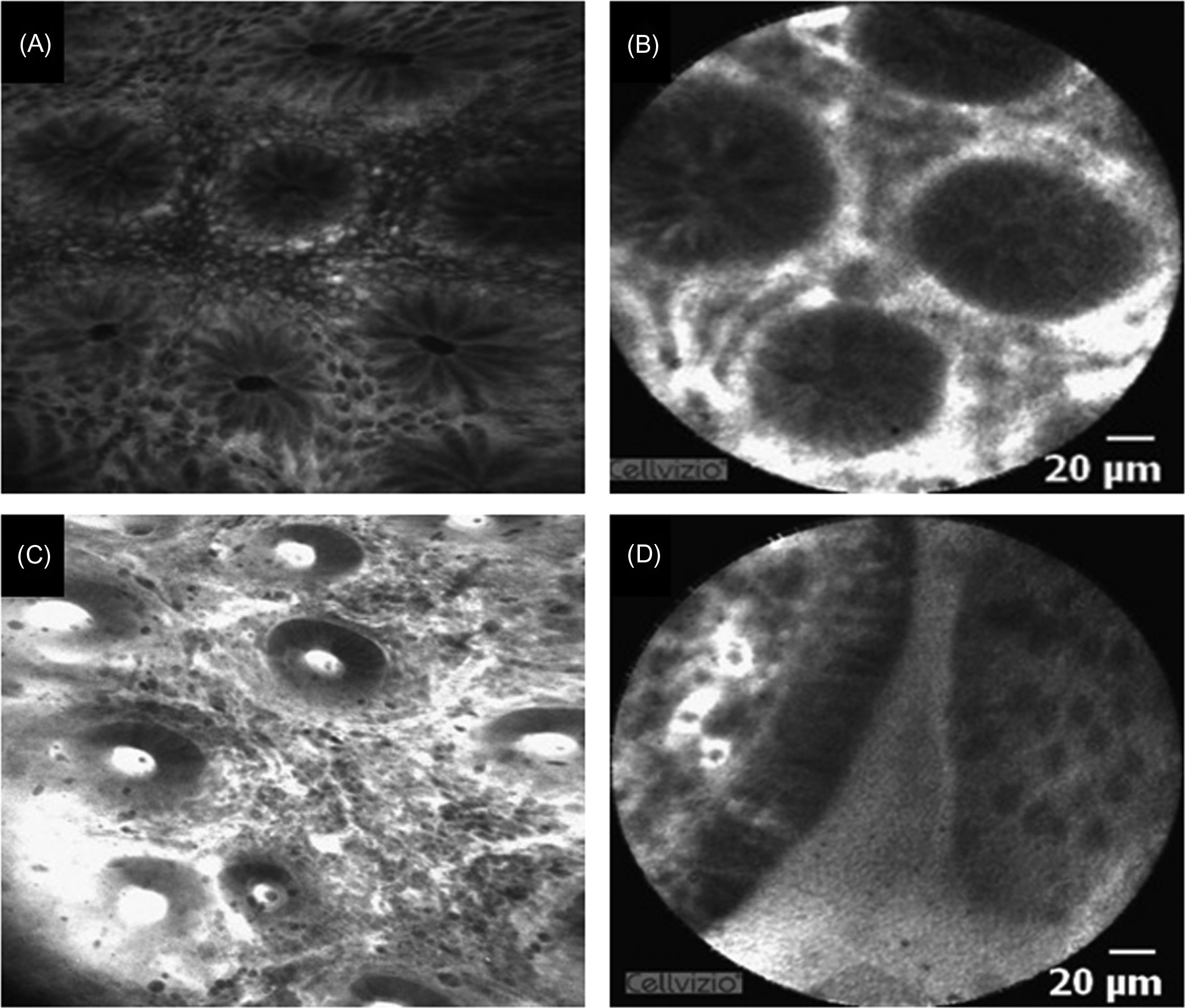 Figure 20.2, Evaluation of noninflamed and inflamed colon mucosa. (A) Noninflamed mucosa on integrated CLE. Colonic crypts, surrounded by dark-appearing goblet cells, became evident; (B) noninflamed mucosa IBD visualized with probe-based CLE. Confocal imaging displays colonic crypts and microvessels in the lamina propria; (C) inflamed mucosa in IBD on integrated CLE. Colonic crypts were variously shaped and irregular. Fluorescein sodium leaked into the lamina propria, highlighting damage of minute mucosal microvessels. (D) Mucosal gaps appearing as white incisions of the mucosal surface on probe-based CLE. These gaps are predictive of an acute flare of the disease within the next 12 months. CLE , Confocal laser endomicroscopy; IBD , inflammatory bowel disease.