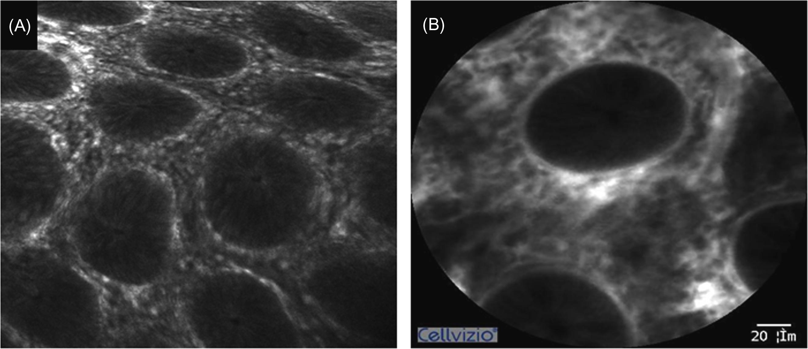 Figure 20.3, Grade A in the CLE classification of ulcerative colitis. Normal-sized crypts are regularly arranged. The lumen of crypts presents as dark spots without fluorescein leakage. (A) Crypts of Grade A observed by endoscope-based CLE; (B) few crypts can be observed by probe-based CLE. CLE , Confocal laser endomicroscopy.