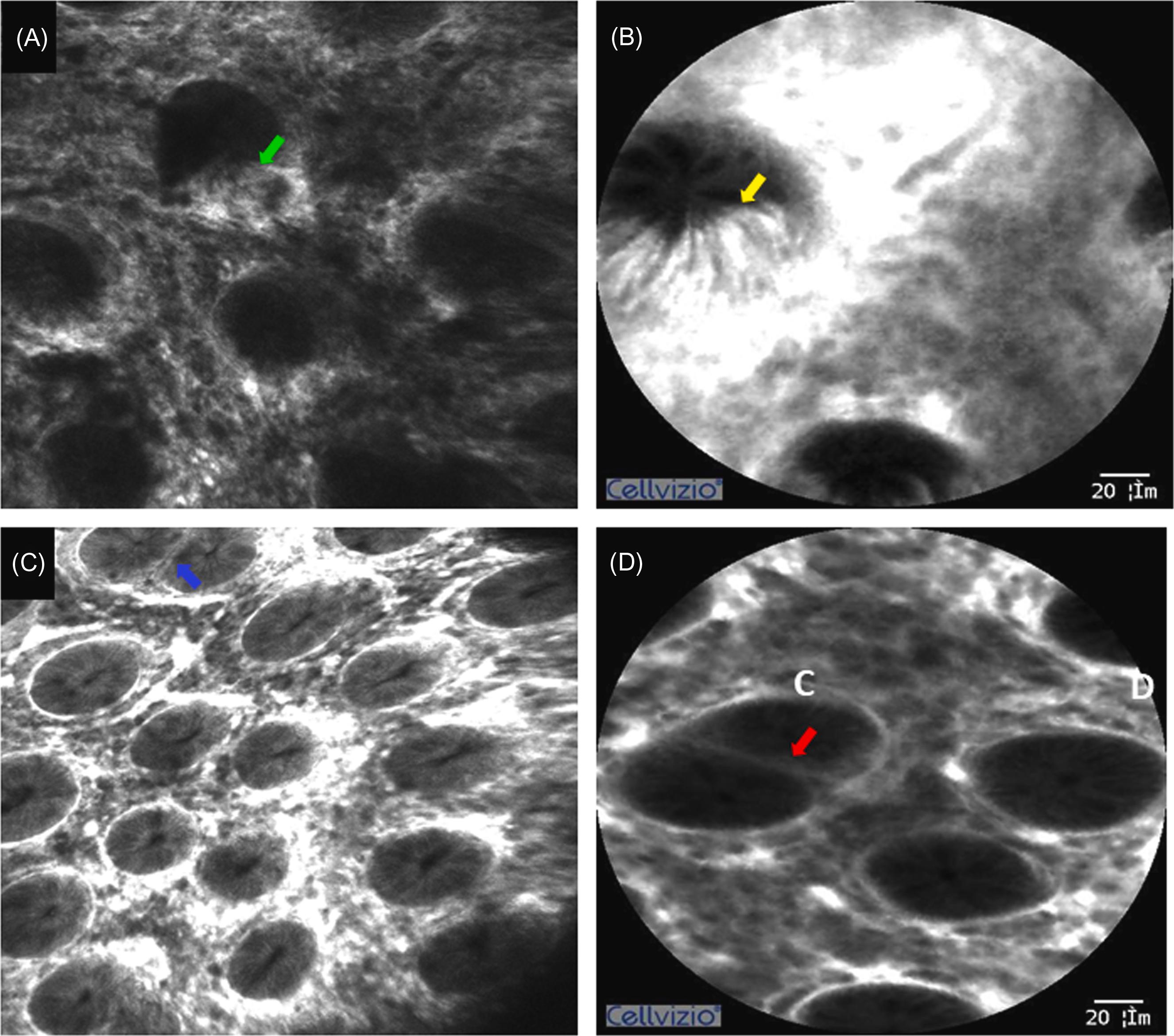 Figure 20.4, Grade B in the CLE classification of ulcerative colitis. Crypts are normal in size but irregularly arranged. The lumen of crypts is free of fluorescein into spaces between epithelial cells. Sporadic crypt fusion can be seen. (A) eCLE: fluorescein leakage in the spaces between epithelial cells ( green arrow ); (B) pCLE: fluorescein leakage in the spaces between epithelial cells ( yellow arrow ); (C) crypt fusion on eCLE ( blue arrow ); (D) crypt fusion ( red arrow ) on pCLE. eCLE , Endoscope-based confocal laser endomicroscopy; pCLE , probe-based confocal laser endomicroscopy.