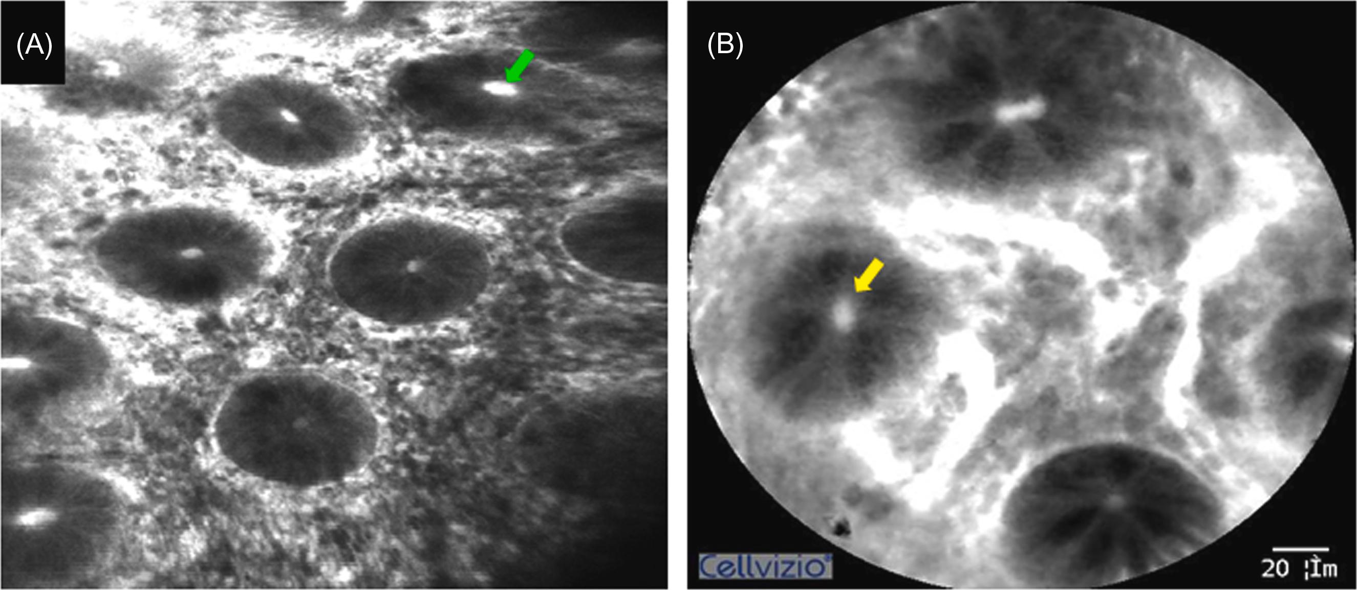 Figure 20.5, Grade C in the CLE classification of ulcerative colitis. Fluorescein leaks into the lumen of crypts shown as bright spots. The epithelium of crypts is intact. (A) eCLE: fluorescein leakage in the lumen of crypts ( green arrow ); (B) pCLE: fluorescein leakage in the lumen of crypts ( yellow arrow ). eCLE , Endoscope-based confocal laser endomicroscopy; pCLE , probe-based confocal laser endomicroscopy.