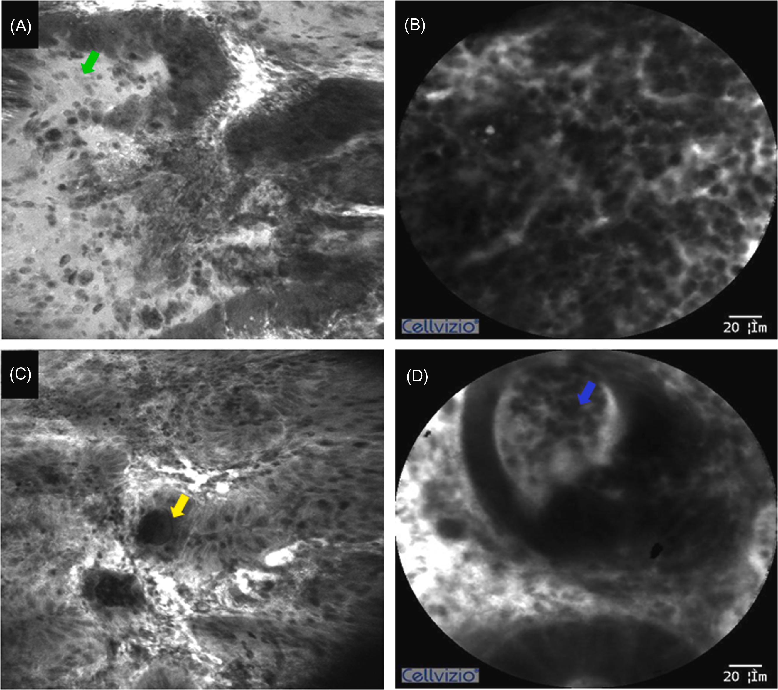 Figure 20.6, Grade D in the CLE classification of ulcerative colitis. Most crypts are replaced by diffuse necrosis, and remaining crypts are destroyed. Crypt abscesses are seen. (A) Destroyed crypts ( green arrow ) and diffuse necrosis on eCLE; (B) diffuse necrosis on eCLE; (C) crypt abscess ( yellow arrow ) on eCLE; (D) crypt abscess ( blue arrow ) on pCLE. eCLE , Endoscope-based confocal laser endomicroscopy; pCLE , probe-based confocal laser endomicroscopy.