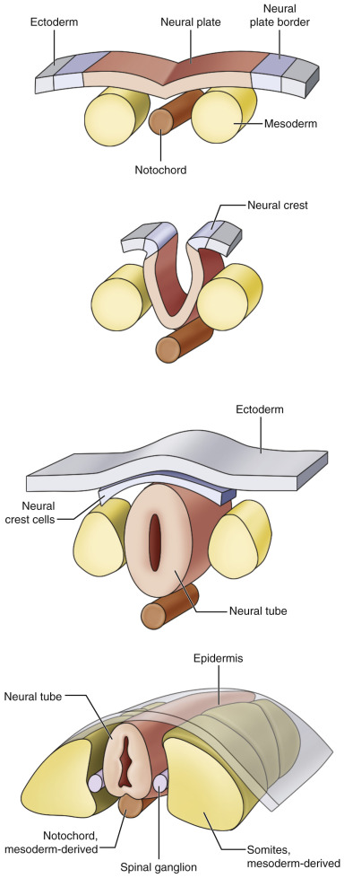 FIG 35-2, Primary neurulation, or closure of the neural tube, is induced by the notochord. The notochord forms in the midline by fusion of the bilateral mesoderm anlage. The neural plate differentiates from the ectoderm and folds in the midline. Its ends join at the neural plate borders, which are referred to as the neural crests. The bilateral neural crests (represented in blue) separate from ectoderm and neural plate during neural tube closure and fragment bilaterally to form spinal sensory ganglia and the peripheral nervous system. While the neural tube is closing, it detaches from the surface ectoderm, and the surface ectoderm closes dorsal to the neural tube to provide a continuous skin covering of the neural tube. This process is called disjunction.