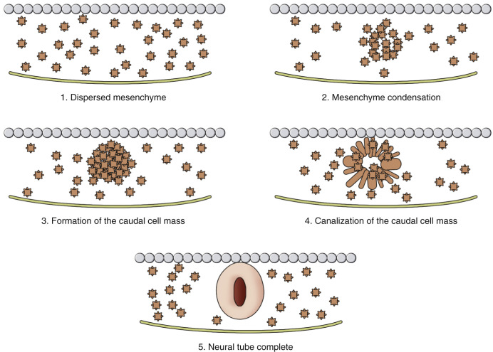 FIG 35-3, Secondary neurulation is responsible for the formation of the tip of the conus medullaris and filum terminale. It refers to formation of a secondary neural tube at the caudal aspect of the primary neural tube. This starts by conglomeration of a caudal cell mass of undifferentiated totipotential cells originating from the caudal end of the primitive streak. The caudal cell mass then undergoes canalization with formation of a central canal. The central canal of the caudal mass merges with the neural tube canal formed during primary neurulation.