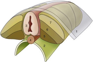 FIG 35-4, Somite separation. The bilateral mesoderm segments into individual somites. Somites separate into sclerotomes (5), dermatomes (7), and myotomes (6). Dermatomes and myotomes remain in place. The sclerotomes migrate to surround the notochord (4) and overlying neural tube (3) and form the vertebral bodies. The myotomes give rise to the paraspinal musculature. 1, ectoderm; 2, endoderm.