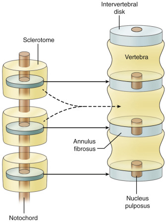 FIG 35-5, Intersegmental formation of the vertebral bodies. Each sclerotome separates into a cranial and a caudal portion that surround the notochord. Fusion of the caudal portion of a sclerotome with the cranial portion of the subjacent sclerotome forms a vertebral body. Intervertebral disks form between the rostral and caudal portions of each sclerotome. The notochord later regresses and only persists as the nucleus pulposus.