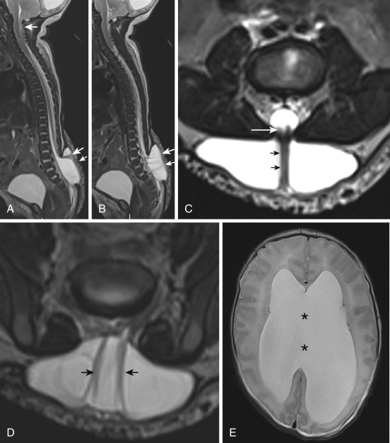 FIG 35-6, Lumbosacral myelomeningocele. A, Midline sagittal T2-weighted image demonstrates absent posterior elements at the lower lumbar and sacral levels. The spinal cord exits at the upper aspect of this dysraphic segment into a meningocele sac ( upper arrow in lumbar region). This segment of the cord consists of a flat nonneurulated placode, which in this patient is adherent to the meningocele sac ( lower arrow in lumbar region). The uppermost arrow in the upper cervical region indicates the pointed cerebellar tonsils, which are herniated into the upper spinal canal, consistent with the almost always (>98% of cases) associated Chiari II malformation. B, Sagittal T2-weighted image off midline shows the cauda equina nerves coursing from the neural placode anteriorly (arrows). C, Axial high-resolution T2-weighted image through the level indicated by the arrows in A shows the nonneurulated placode (white arrow) exiting the spinal canal and coursing in the meningocele sac toward its posterior wall (small black arrows). D, Axial high-resolution T2-weighted image at a lower level through the meningocele sac demonstrates nerves (black arrows) coursing from the placode anteriorly. E, Axial T2-weighted image at the level of the lateral ventricles showing the ventricular dilatation that frequently complicates the altered CSF dynamics as a result of the crowded craniocervical junction. The septum pellucidum is absent (*). This is a common finding in Chiari II malformation. It represents destruction of the septum pellucidum secondary to high intraventricular pressure.