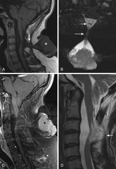 FIG 35-7, Cervical myelocystocele complicated by squamous cell carcinoma (an extremely rare occurrence). A 22-year-old presented with a mass in the back of his neck since birth, which started bleeding recently. A, Midline sagittal T1-weighted image demonstrates the typical appearance of a narrow posterior spinal dysraphic defect (arrow) through which neural elements and dura exit into a large meningocele sac. B, Axial T2 image shows that the cord remains in the spinal canal (short anterior arrow) and dysmorphic neural elements from the dorsal aspect of the cord are stretched into the meningocele sac (long posterior arrow). C, Postcontrast sagittal T1 image with fat saturation shows an enhancing mass (*) in the posterior subcutaneous tissues, pathologically confirmed to represent squamous cell carcinoma, a very rare complication of this very rare malformation. D, Sagittal T2 sequence after tumor resection better demonstrates the neural elements stretched from the dorsal cord into the meningocele sac (arrow) . The cord itself remains in the spinal canal.