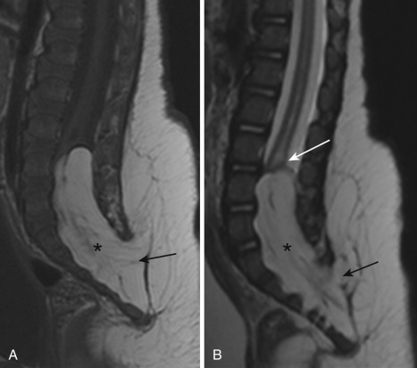 FIG 35-8, Lipomyeloschisis. A, Sagittal T1 image best demonstrates the T1-hyperintense large lipoma (*) extending through a wide spinal dysraphic defect (black arrow) to the subcutaneous fat. B, The terminal placode-lipoma interface lies within the spinal canal (white arrow). The subarachnoid space ventral to the placode is not expanded. Note the mild hydromyelia that not infrequently complicates spinal cord tethering.