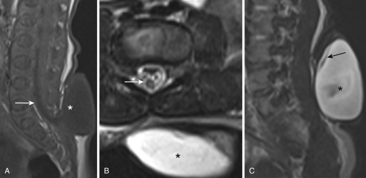 FIG 35-9, Posterior meningocele. One-day-old with prenatal diagnosis of lumbosacral meningocele. A, Sagittal T1 image shows a wide lumbosacral spinal dysraphic defect with a meningocele sac herniating at this site (*). The cord is low lying (arrow) and tethered at the site of attachment of the meningocele. B, Axial T2 at the level of the meningocele (*) demonstrates the low-lying conus in the spinal canal (arrow). C, Sagittal T2 image demonstrates a nerve (arrow) herniated in the meningocele (*) (surgically confirmed).