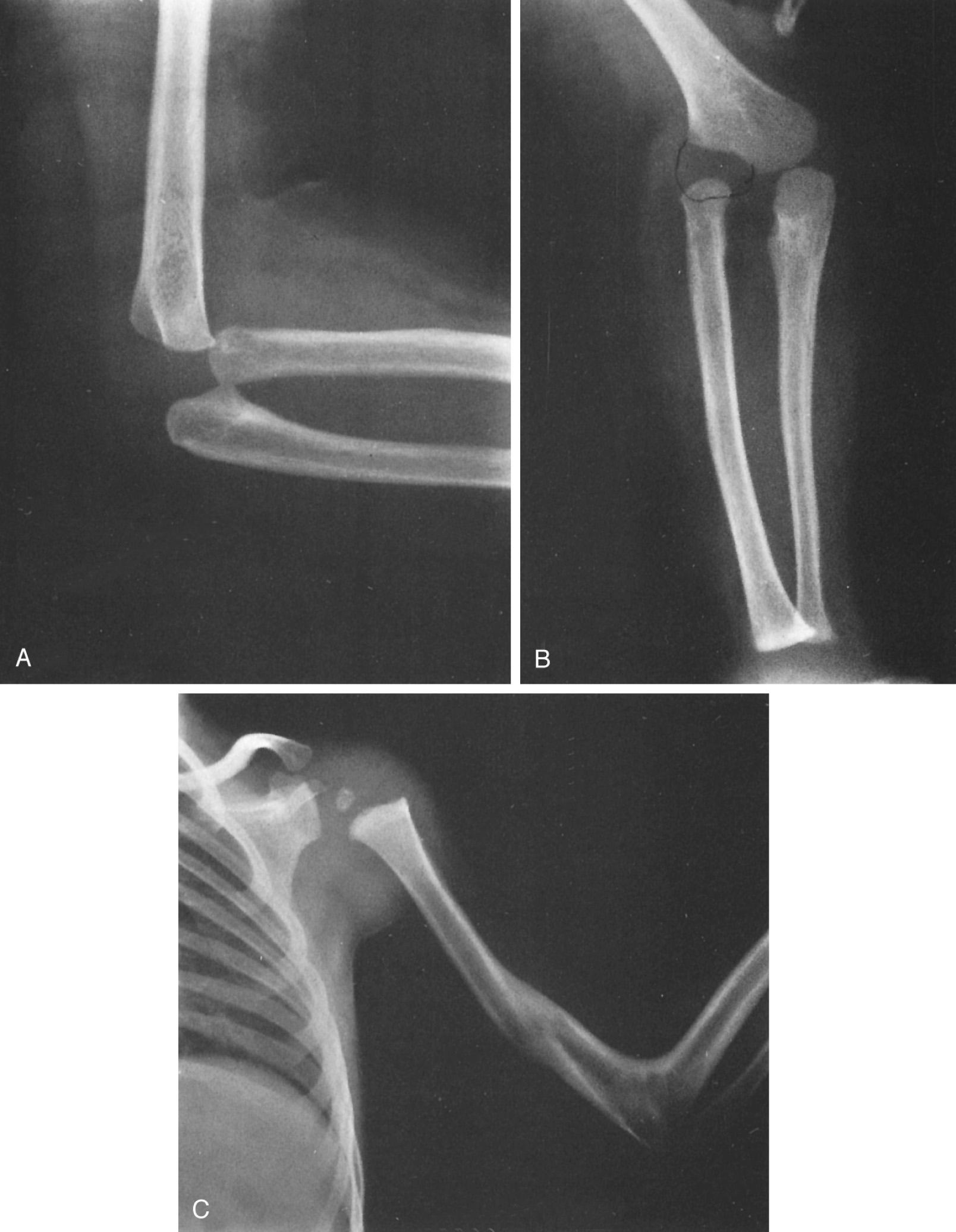 FIG 26.1, Lateral (A) and anteroposterior (B) x-ray views of a hypoplastic distal humerus and an apparent radial head subluxation certainly reveal a deformity but probably not a subluxation. Clinically, there was no evidence of a dislocated radial head. (C) The opposite elbow showed a radiohumeral synostosis and also a recent fracture just proximal to the synostosis. This case demonstrates the difficulties of differentiation between subluxation, dislocation, and synostosis about the elbow, but the etiology is clearly congenital.