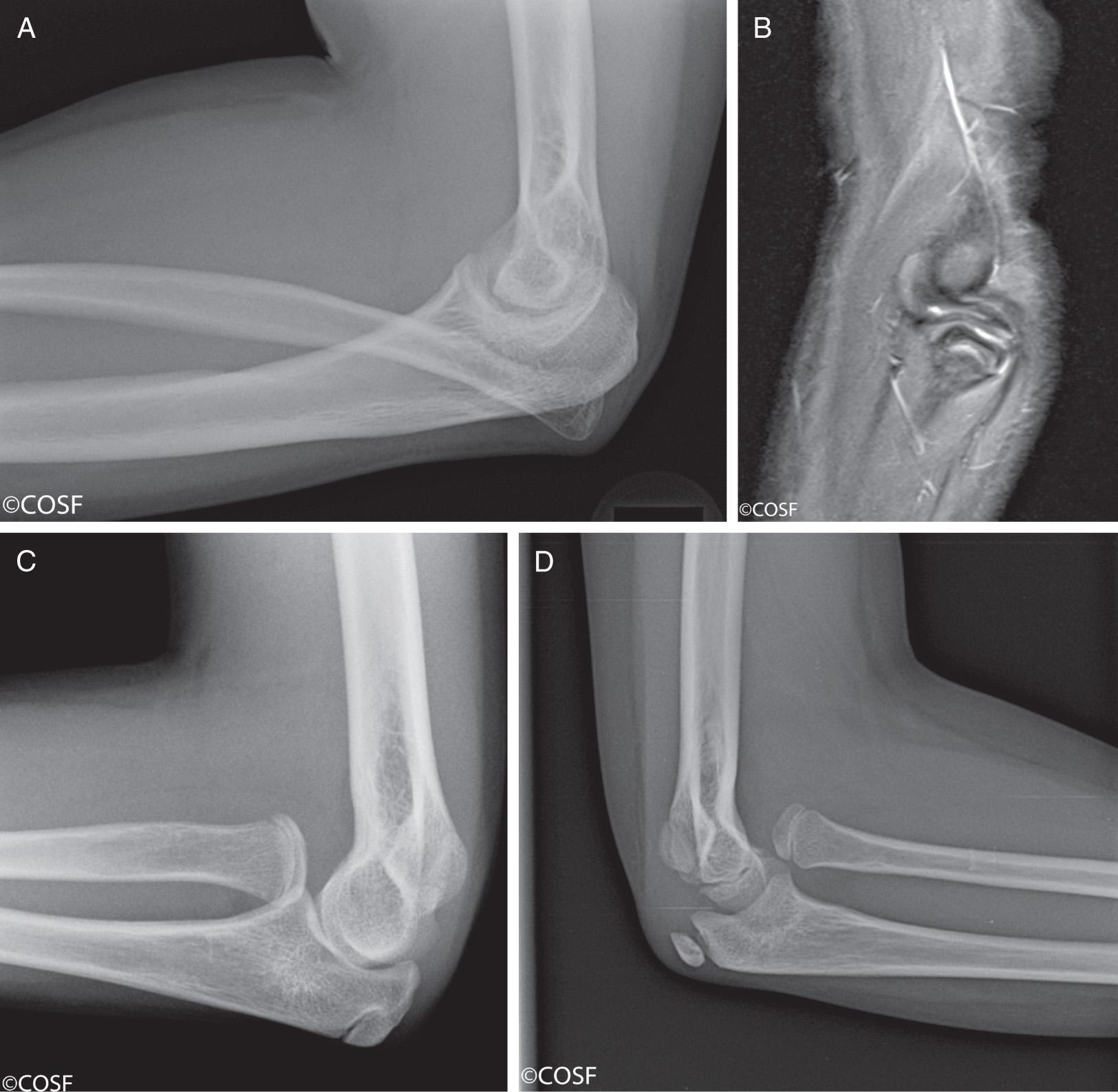 FIG 26.11, (A) Posterior congenital radial head dislocation. (B) MRI showing congenital radial head dislocation with abnormal positioning of the annular ligament. (C) Anterior congenital dislocation of the radial head. (D) Long-standing posttraumatic anterior dislocation of the radial head.