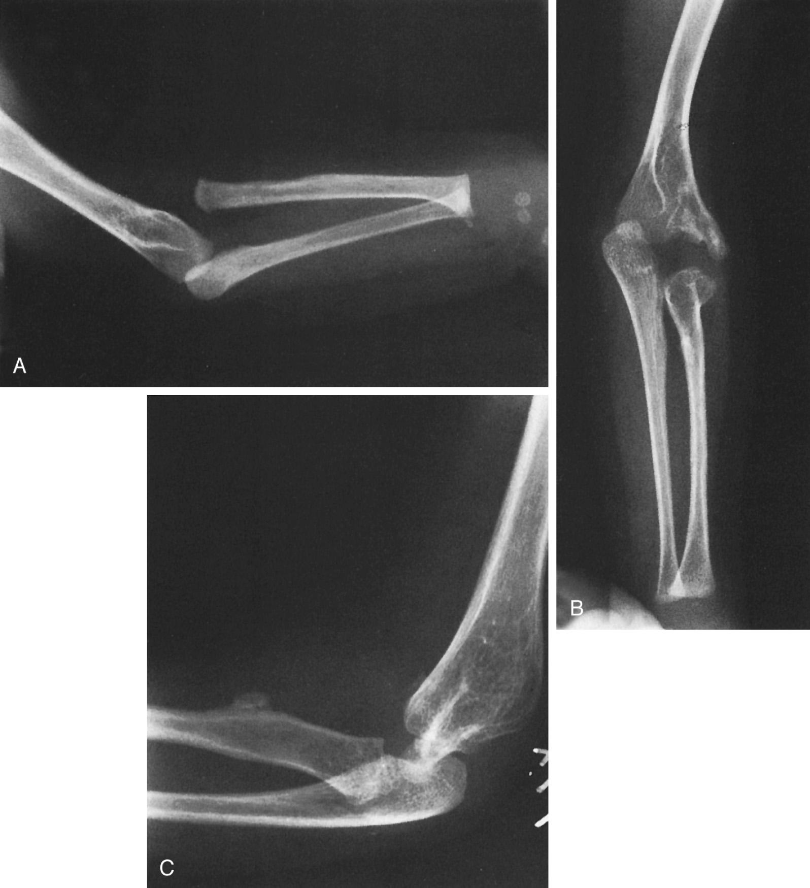 FIG 26.12, (A) Anteroposterior (AP) x-ray view of an apparent radiohumeral dislocation is seen preoperatively. (B) A postoperative AP x-ray view 4 years later shows repositioning of what was determined to be a congenital displaced radiohumeral joint without a dislocation of the radial head. (C) A lateral postoperative view of the same elbow. Repositioning was obtained when the radius was shortened by removing a segment of the radial shaft. This segment of excised radius was then used to block the repositioned lateral condyle in its new position. This surgical procedure improved the x-ray position of the elbow but did not change function, which demonstrated both preoperatively and postoperatively mild loss of extension-flexion and moderate loss of supination-pronation.