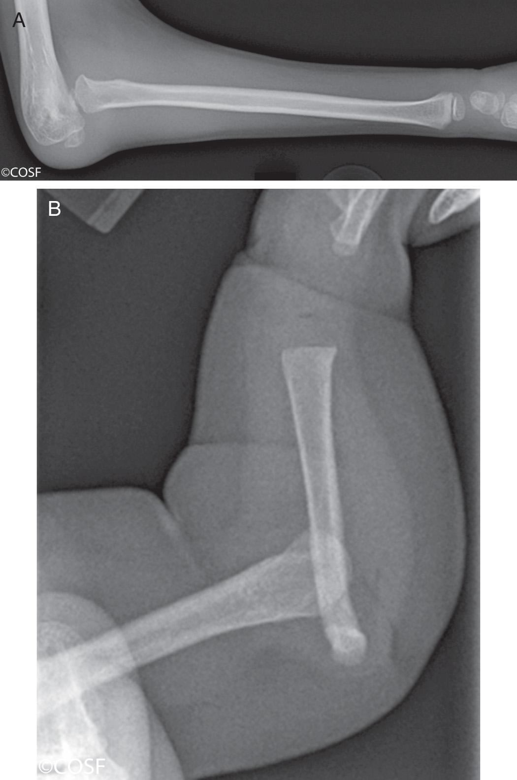 FIG 26.13, Ulnohumeral dislocations. (A) Complete congenital absence of the ulna with preservation of radial length. (B) More typical complete absence of the ulna and proximal migration of the radius.