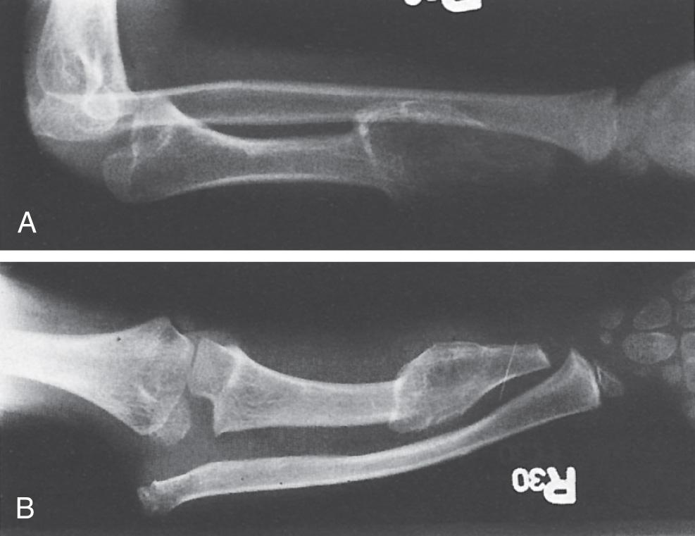 FIG 26.3, This case further demonstrates the overlap between congenital and developmental abnormalities of the elbow. Gradual radial head subluxation due to unequal length of forearm bones is well known in multiple exostosis. These anteroposterior and lateral x-rays demonstrate a severe dislocation of the radial head that was present at birth and was associated with a severe osteochondroma deformity of the distal ulna with inhibition of ulnar growth.