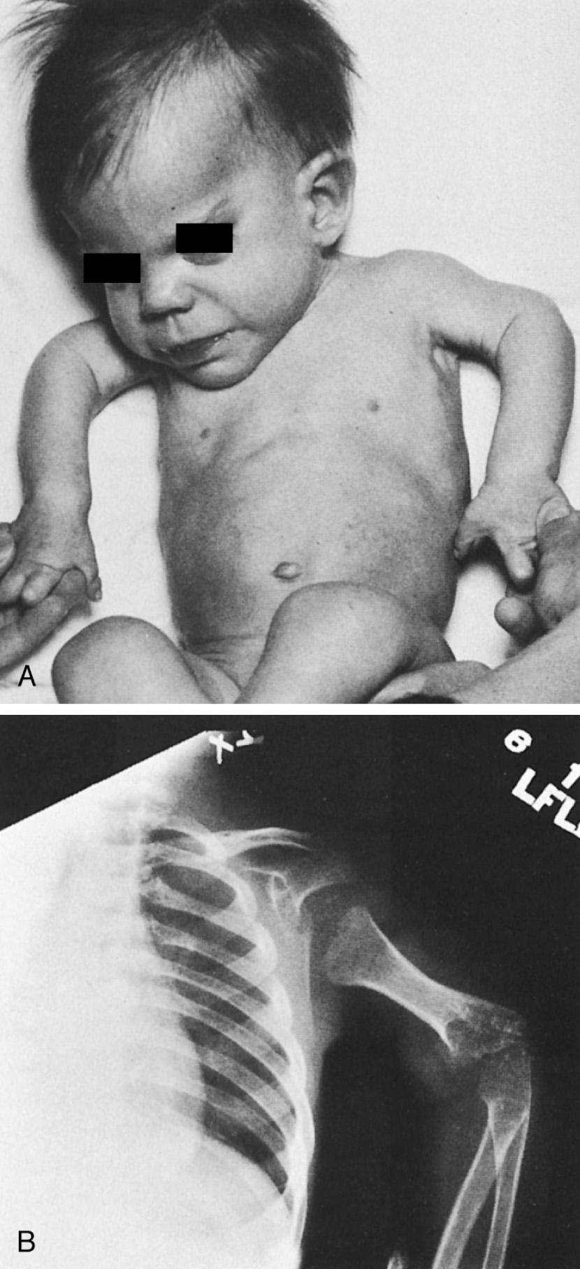 FIG 26.4, (A) This 18-month-old infant with chondrodysplasia punctata has developmental contractures of many joints including the elbows, where broad metaphyses and irregular, calcified epiphyses (B) are seen.