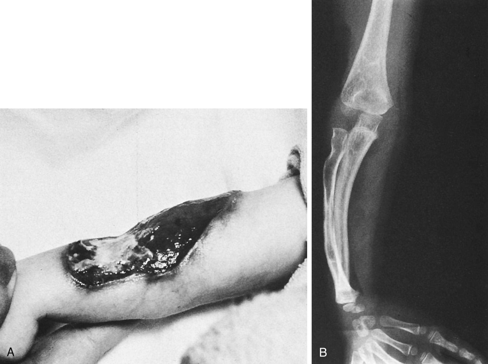FIG 26.5, (A) Congenital aplasia of skin and soft tissues at the elbow and proximal forearm results in developmental bone changes (B) in the forearm and elbow.