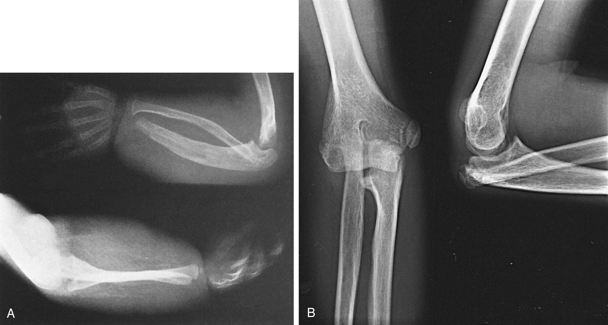 FIG 26.6, (A) The anteroposterior (AP) and lateral x-rays of the elbow and forearm in a patient with juvenile fibromatosis reveal marked enlargement of the ulna, posterolateral subluxation of the radial head, moderate enlargement of the distal humerus, and surface irregularities at all aspects of the joint. The changes in the elbows are developmental. (B) A much more typical congenital posterior radial head dislocation is revealed in these AP (A) and lateral views (B) of the elbow of a 14-year-old male with nail-patella syndrome and restricted elbow-forearm motion: 30 to 155 degrees' flexion extension; 45 degrees' supination; 60 degrees' pronation. His mother has the same diagnosis and the same problem.